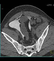 Perforated Bladder With Intraperitoneal Contrast - CTisus CT Scan