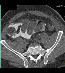 Perforated Bladder With Intraperitoneal Contrast - CTisus CT Scan