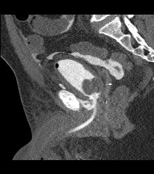 Perforated Bladder With Intraperitoneal Contrast - CTisus CT Scan