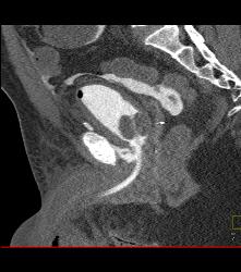 Perforated Bladder With Intraperitoneal Contrast - CTisus CT Scan