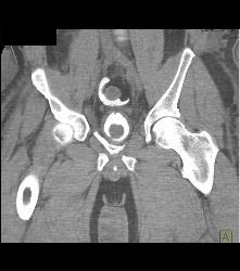 Perforated Bladder With Intraperitoneal Contrast - CTisus CT Scan