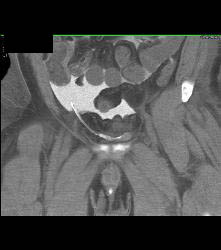 Perforated Bladder With Intraperitoneal Contrast - CTisus CT Scan