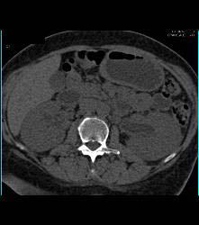 Bladder Cancer With Obstruction - CTisus CT Scan