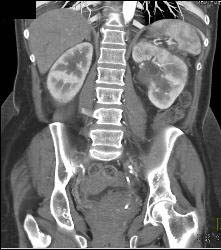 Bladder Cancer With Obstruction - CTisus CT Scan