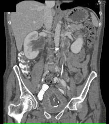 Bladder Cancer With Obstruction - CTisus CT Scan