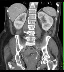 Bladder Cancer With Obstruction - CTisus CT Scan