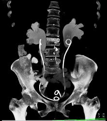 Bladder Cancer With Obstruction - CTisus CT Scan