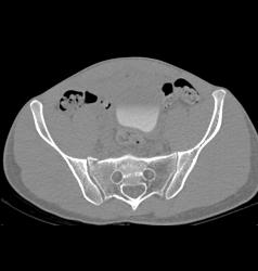 Pelvic Fractures and Hematoma Without Bladder Rupture - CTisus CT Scan