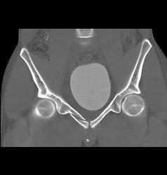 Pelvic Fractures and Hematoma Without Bladder Rupture - CTisus CT Scan