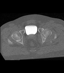 Pelvic Fractures and Hematoma Without Bladder Rupture - CTisus CT Scan