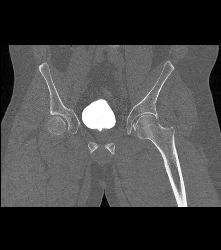 Pelvic Fractures and Hematoma Without Bladder Rupture - CTisus CT Scan