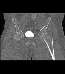 Pelvic Fractures and Hematoma Without Bladder Rupture - CTisus CT Scan