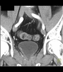 Bladder Cancer With Faint Calcification - CTisus CT Scan