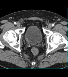 Bladder Cancer With Faint Calcification - CTisus CT Scan