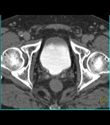 Bladder Cancer With Faint Calcification - CTisus CT Scan