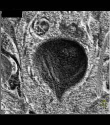 Bladder Cancer With Faint Calcification - CTisus CT Scan