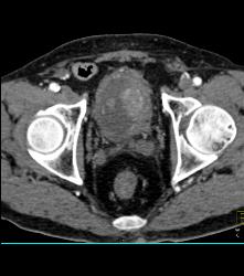 Bladder Cancer - CTisus CT Scan