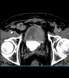 Bladder Cancer - CTisus CT Scan