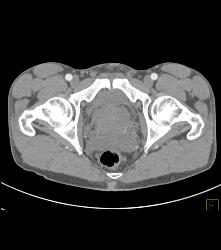 Bladder Cancer - CTisus CT Scan