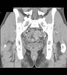 Bladder Cancer - CTisus CT Scan