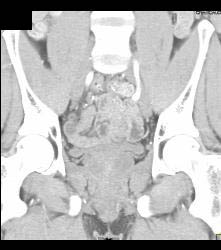 Bladder Cancer - CTisus CT Scan