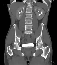 Bladder Cancer - CTisus CT Scan