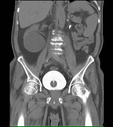 3D Bladder With Foley Catheter - CTisus CT Scan