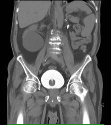 3D Bladder With Foley Catheter - CTisus CT Scan