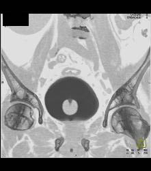 3D Bladder With Foley Catheter - CTisus CT Scan