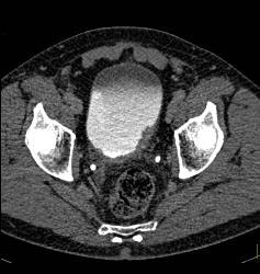 Bladder Cancer - CTisus CT Scan