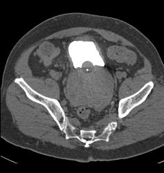 Huge Prostate With Bladder Wall Thickening - CTisus CT Scan