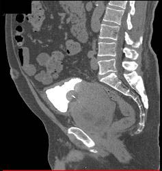 Huge Prostate With Bladder Wall Thickening - CTisus CT Scan