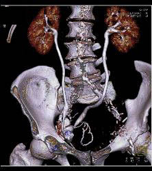 Neobladder - CTisus CT Scan