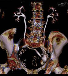 Neobladder - CTisus CT Scan