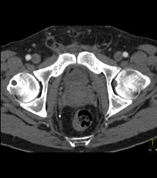 Pelvic Hematoma S/p Prostatectomy - CTisus CT Scan