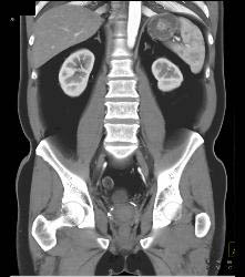 Pelvic Hematoma S/p Prostatectomy - CTisus CT Scan