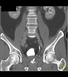 Pelvic Hematoma S/p Prostatectomy - CTisus CT Scan