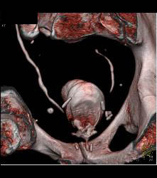 Pelvic Hematoma S/p Prostatectomy - CTisus CT Scan