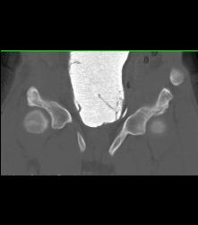 Neobladder With Leak - CTisus CT Scan