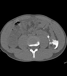 Bladder Injury With Leak - CTisus CT Scan