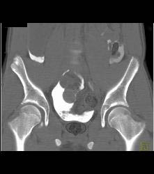 Bladder Injury With Leak - CTisus CT Scan