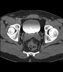 Tumor At Right Ureterovesical Junction (UVJ) - CTisus CT Scan