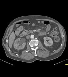 Tumor At Right Ureterovesical Junction (UVJ) - CTisus CT Scan