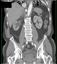 Tumor At Right Ureterovesical Junction (UVJ) - CTisus CT Scan