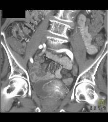 Bladder Cancer in Multiple Phases - CTisus CT Scan