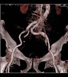 Bladder Cancer in Multiple Phases - CTisus CT Scan