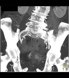 Bladder Cancer in Multiple Phases - CTisus CT Scan