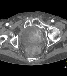 Bladder Cancer in Multiple Phases - CTisus CT Scan