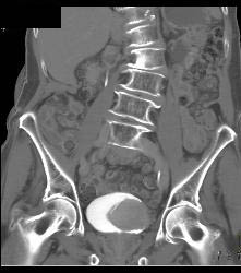 Bladder Cancer in Multiple Phases - CTisus CT Scan