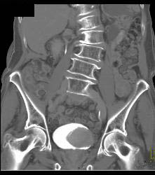 Bladder Cancer in Multiple Phases - CTisus CT Scan